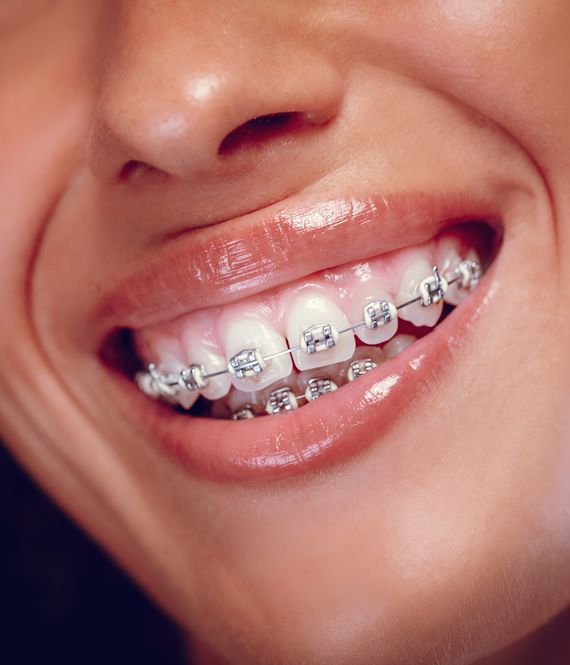 How Long Does Orthodontic Treatment Take For Braces_